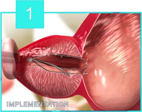 iTind Procedure implementation