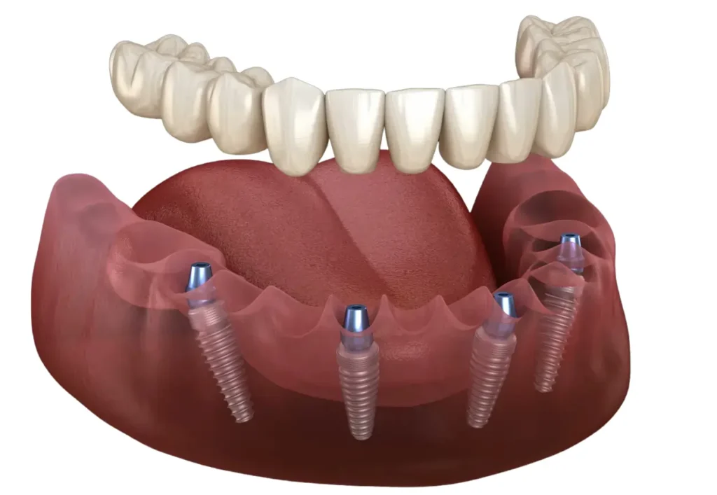 dental implants Turkey all on 4