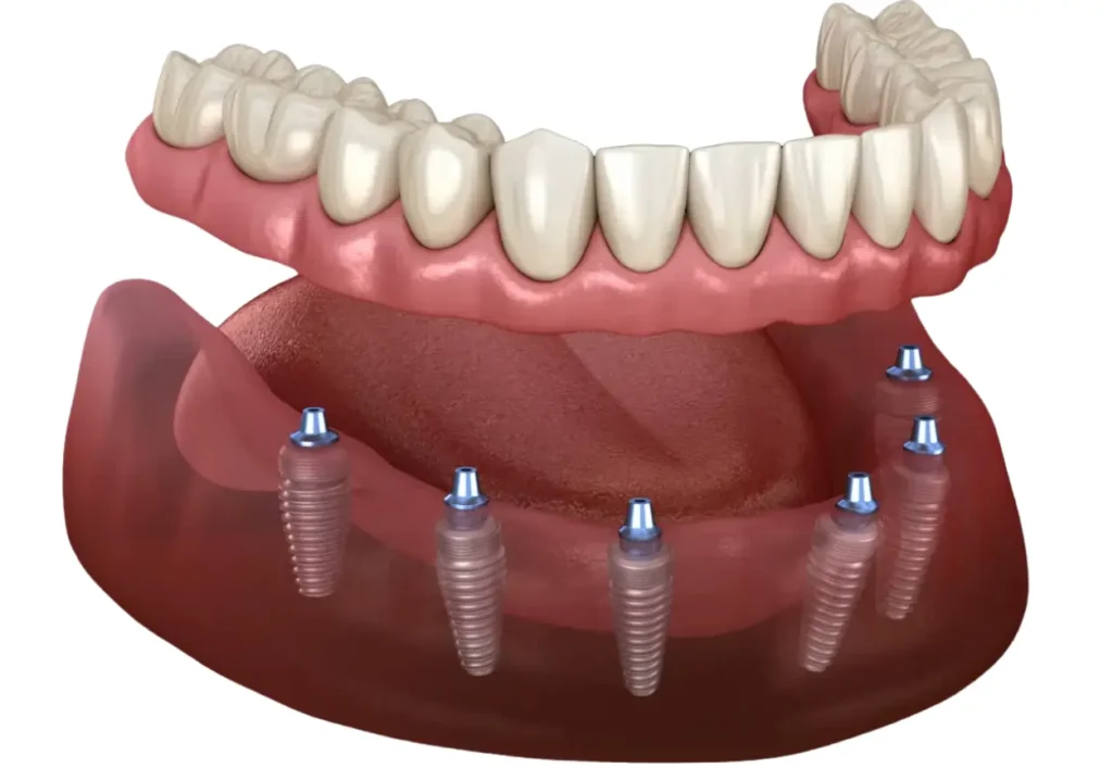 dental implants Turkey all on 6