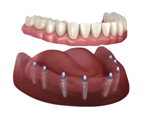 Full Mouth Dental Implants Turkey Package Deals